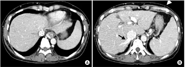 Fig. 4. Follow-up computed tomography image at 3 months shows complete thrombosis of the three main hepatic veins (A), intrahepatic collateral flow drainage through the right inferior hepatic vein (arrow), and collapsed subcutaneous collateral veins  (arro