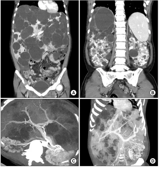 Fig. 1. Computed tomography  images of the abdomen. Multiple cysts occupied the liver (A) and  both kidneys (B), but the hepatic arterial and portal venous flow  was well preserved (C) and  hep-atic veins were extrinsically  com-pressed (D).