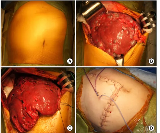 Fig. 4. Operative findings of the  patient undergoing open  fenes-tration surgery. Enlarged liver  was bulged out of the abdomen  (A); There were numerous liver  cysts, but the majority of liver  parenchyma was preserved (B); 