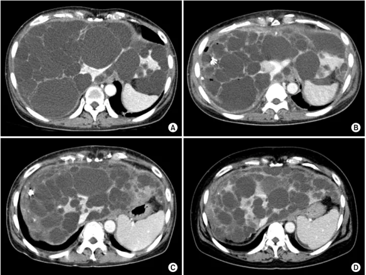 Fig. 5. Computed tomography follow-up of the abdomen. Multiple distended cysts occupied the liver just before surgery (A); 