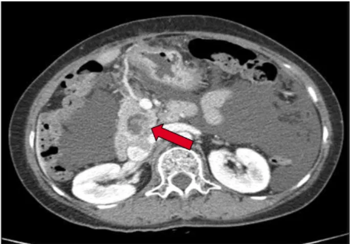 Fig. 2. Computed tomography scan showing bilateral enlarge- enlarge-ment of ovaries (arrows) with huge amount of ascites.