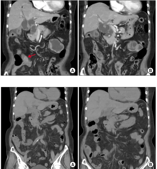 Fig. 1. Initial computed tomog- tomog-raphy finding showing a  radio-paque stone (arrow) at the  up-stream afferent loop bowel (A)  with concentric bowel wall  thickening and dilatation of the  segmental jejunal loop (B).