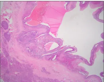 Fig. 5. A high-power view filed of the cyst-lining shows  stratified squamous epithelium covering lymphoid tissue  con-taining a lymphoid follicle (H&amp;E, ×200).