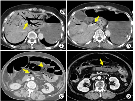Fig. 2. Portomesenteric venous  gas at different anatomical  loca-tions in various patients