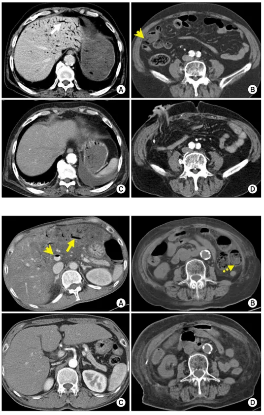 Fig. 3. A 77-year-old man with  superior mesenteric artery  occlu-sion underwent ascending colon  and small bowel resection and  loop ileostomy