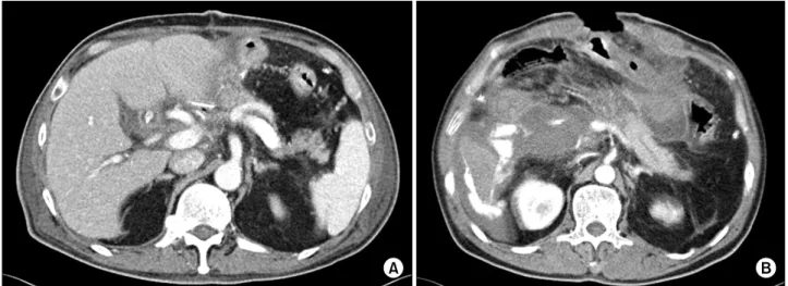 Fig. 2. Presentation of morbidity and mortality cases. (A) Computed tomography 7 days after BPJ due to an ampulla of Vater  cancer