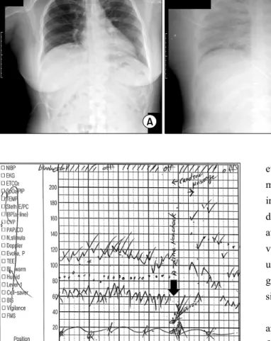 Fig. 1. (A) Preoperative chest  x-ray. (B) Postoperative chest  x-ray.