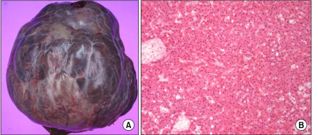 Fig. 3. Gross and microscopic  findings showing a pedunculated hepatic mass (A) and a  micro-photopraph representing  hepato-cellular carcinoma (HE ×200) (B).