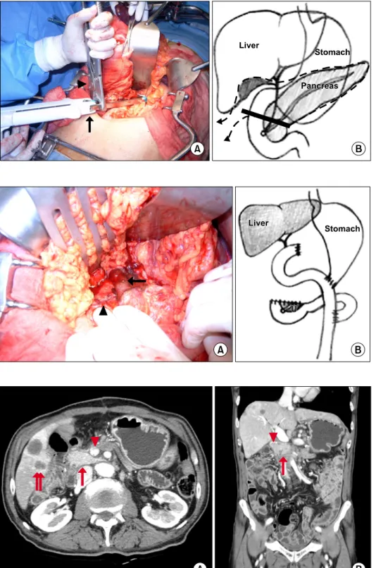 Fig. 3. Operative procedures. (A)  Operative field after resection. 
