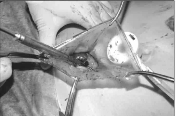 Fig. 2. Decompression of hemangiomas during retrieval to de- de-crease the size of incision