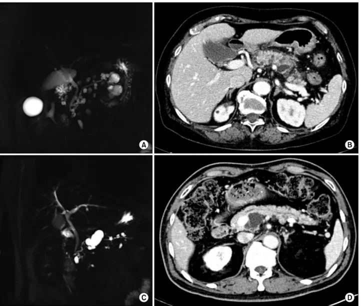 Fig. 2. Radiologic findings of multifocal intraductal papillary mucinous neoplasms. (A and B) MRI and CT scan revealed pancreas swelling with peri-pancreatic infiltration, implying acute pancreatitis