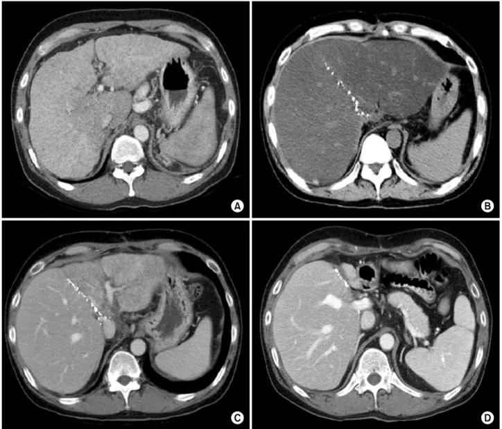 Fig. 2. Computed tomography (CT) follow-up of a 35-year-old male patient who showed severe alcohol intake after living donor  liver transplantation using dual liver grafts