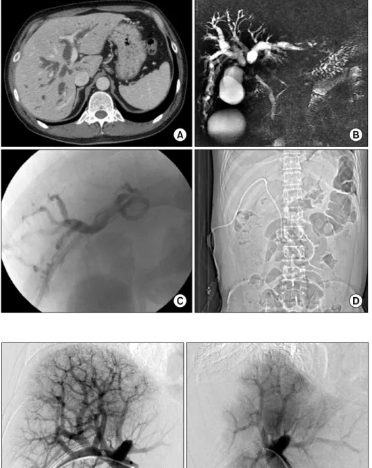 Fig. 1. Imaging finding of a pa- pa-tient with perihilar  cholangiocar-cinoma. (A) Initial computed  to-mography image; (B) Initial  mag-netic resonance cholangiography; 