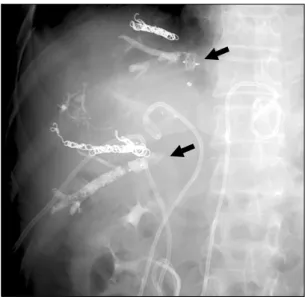 Fig. 4. Insertion of a new percutaneous transhepatic biliary  drainage tube into the left hepatic duct.