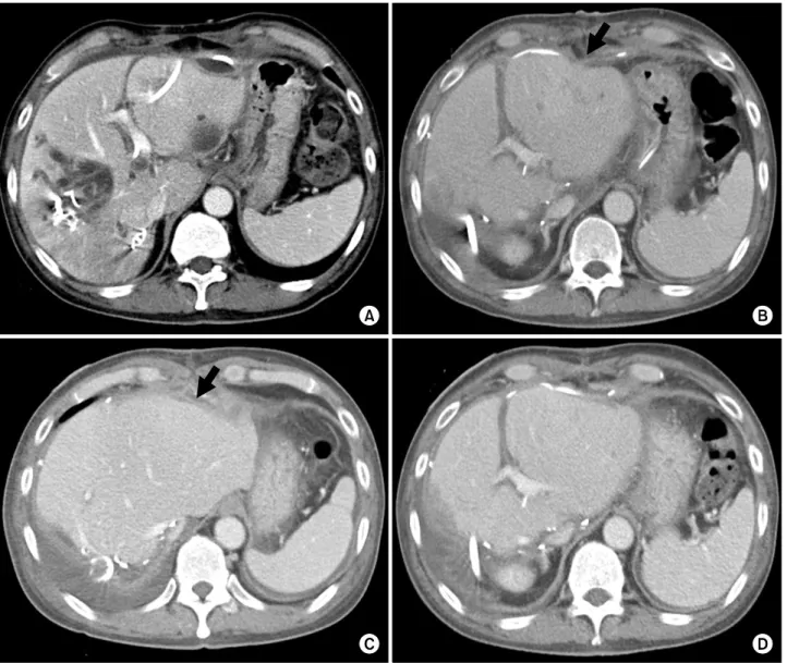 Fig. 6. Perioperative changes of computed tomography (CT) findings. (A) Liver CT taken 2 days before surgery; (B) Liver CT taken 5 days after surgery