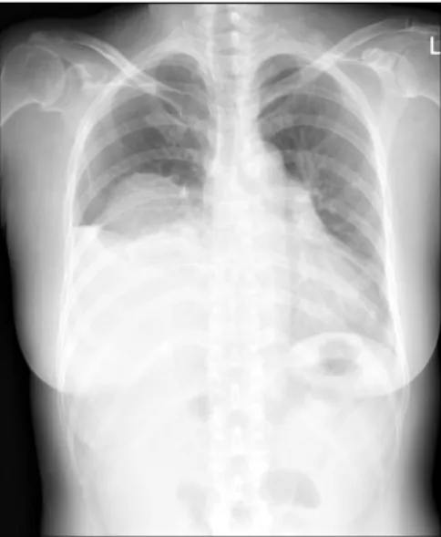 Fig. 1. Chest PA revealing higher positioning of the right  hemi-diaphragm.