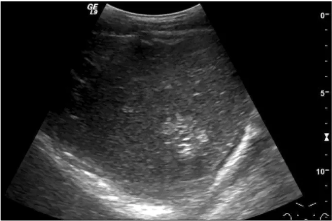 Fig. 1. Ultrasonogram demonstrating a multiseptated cystic  mass at the segment VI.