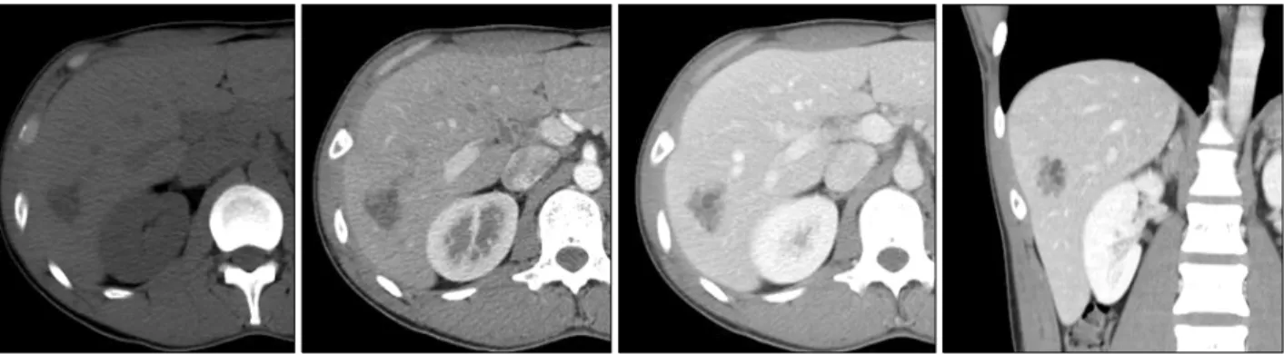 Fig. 2. Computed tomography scan showing a multiseptated non-enhancing cystic mass at the segment VI.