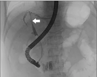 Fig. 2. Abdominal CT reveals another newly appeared abscess pocket in the right basal lung and a fistula (arrow) showing  communications between the radiofrequency-ablated cavity in the liver and the bronchial tree, including the pneumonic  con-solidation 