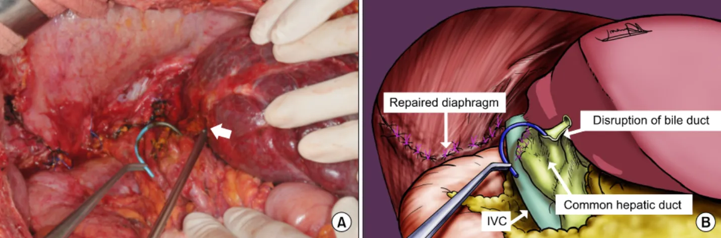 Fig. 3. (A) Operative field after right posterior sectionectomy and primary repair of the diaphragmatic defect shows exposure  of left biliary stent (clamping with curved forceps) and opening of the left hepatic duct (arrow)