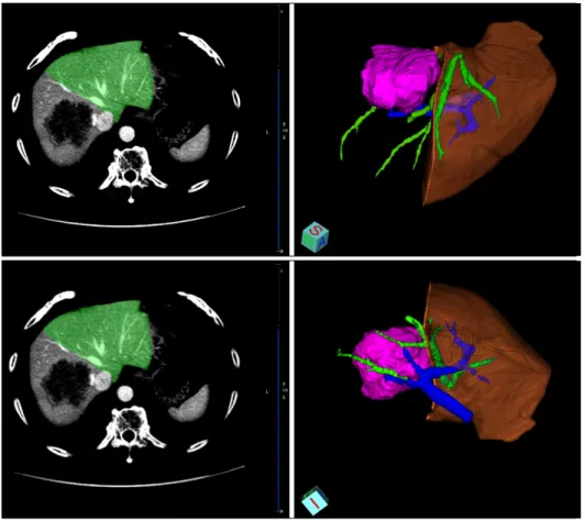 Fig. 1. Virtual resection of the  liver. The transection line of the  virtual liver resection followed  the middle hepatic vein