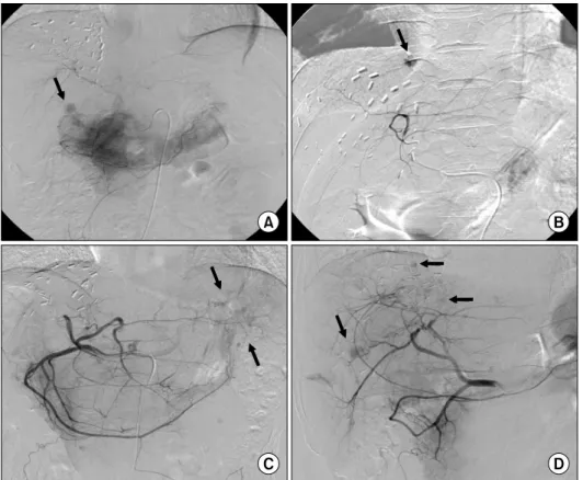Fig. 1. Patterns of intrahepatic  metastasis at 1-month protocol  transarterial chemoinfusion