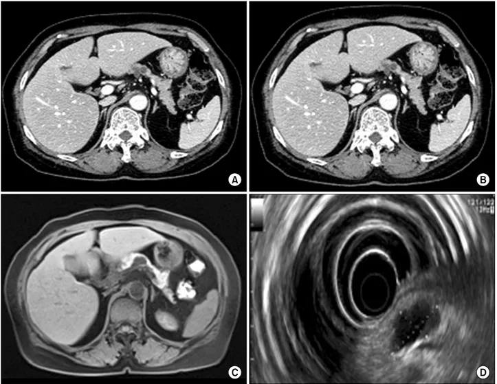 Fig. 1. Pancreas dynamic CT showed cystic lesions (A and B). The largest lesion measured 2.2 cm