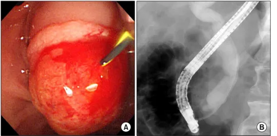 Fig. 2. ERCP findings. (A) Huge and prominent papilla was noted on ERCP. (B) ERCP  cholangio-gram also revealed dilated  com-mon bile ducts with  asym-metrical irregular strictures.