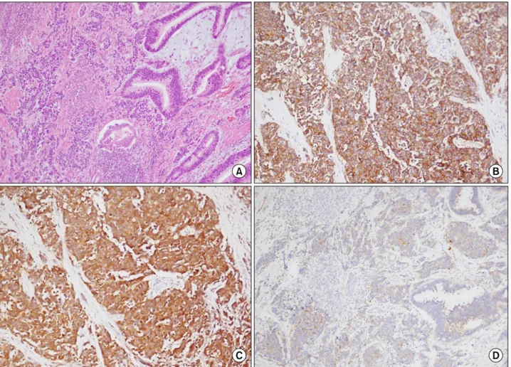 Fig. 3. Microscopic findings. (A) Collision site shows abrupt morphologic alterations between usual adenocarcinoma and poorly differentiated endocrine carcinoma (hematoxylin &amp; eosin, ×100)