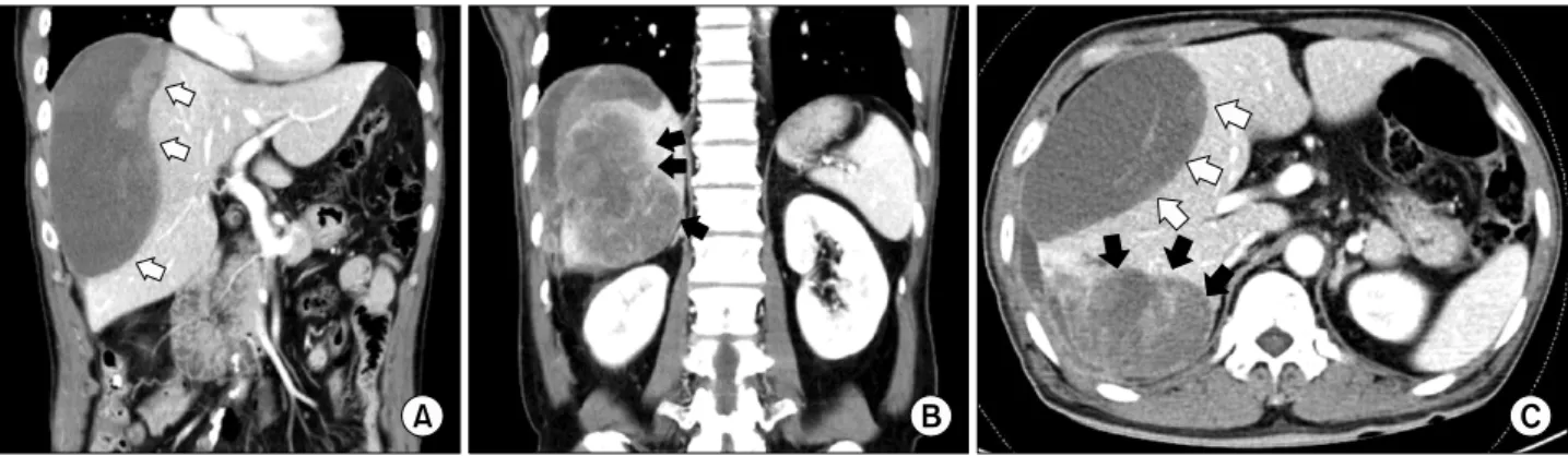 Fig. 1. Computed tomography (CT) images show (A) a homogenous low density lesion in the anterior section of the liver (white arrows); (B) heterogeneous enhanced mass lesion in the delayed phase with enhanced peripheral bile duct in the posterior section (b