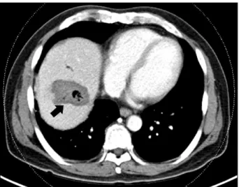 Fig. 2. A follow-up computed tomography shows liver ab- ab-scess with inserted pigtail catheter in the previous  radio-frequency ablated site (black circle) and consolidation with air formation in the adjacent diaphragm, which was diagnosed as a lung absce