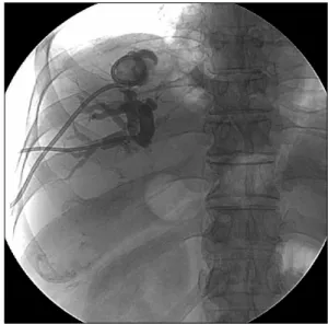 Fig. 6. After the percurtaneous drainage catheter was re- re-moved, contrast material was injected through PTBD catheter.