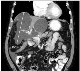 Fig. 1. Postcontrast abdominal computed tomography shows  a large intrahepatic fluid collection at the resected bed.