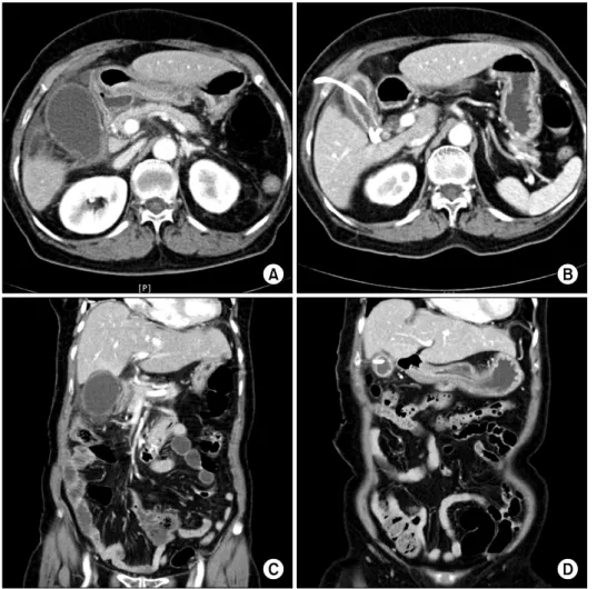 Fig. 1. Axial (A, B) and coronal  (C, D) CT images of empyema  of the gallbladder in an 82  year-old female patient