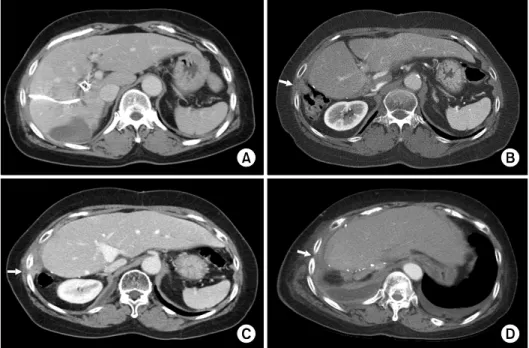 Fig. 4. Computed tomography  images of the sequences of  per-cutaneous transhepatic biliary  drainage (PTBD) tract  recur-rence