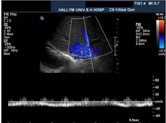 Fig. 1. Doppler sonogram obtained on the fourth post- post-operative day. The spectral Doppler waveform of the middle  hepatic vein shows a mono-phasic flow pattern suggesting  hepatic outflow stenosis.