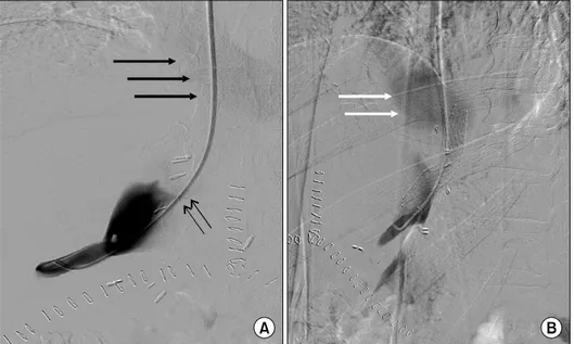 Fig. 4. Follow-up CT images at  1 day after stent insertion. (A)  The CT image shows a patent  stent without narrowing in the  cavo-caval anastomosis