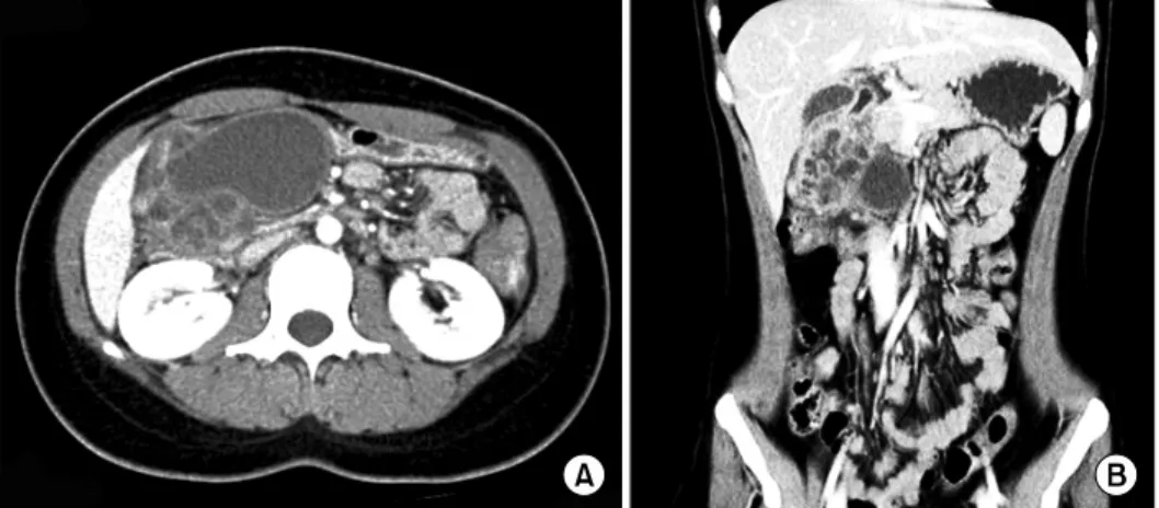 Fig. 2. Magnetic resonance imaging study showing a definitive cystic mass in T2 weighted imaging