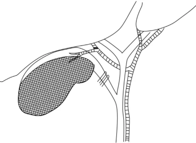 Fig. 1. Illustration of the surgical technique. The gallbladder  infundibular serosa dissected and the cystic duct was clipped twice
