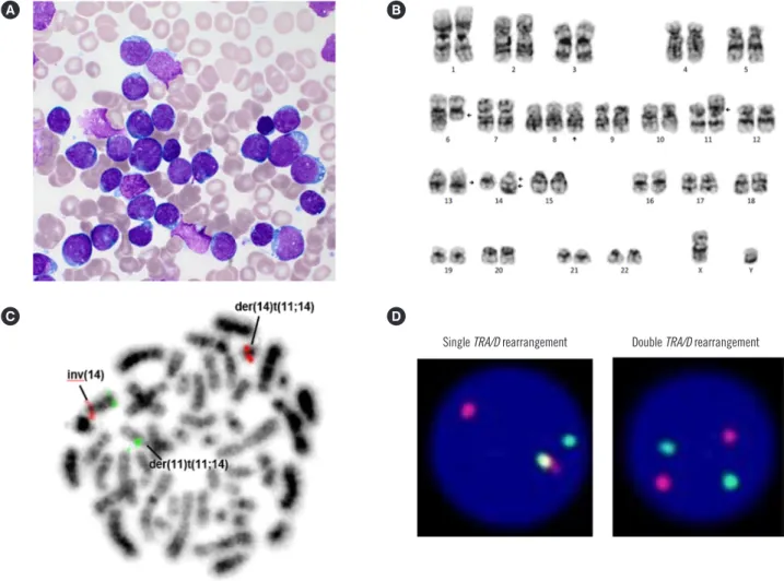 Fig. 1. BM examination, karyotyping, and FISH analysis at diagnosis. (A) Lymphoblasts on the BM aspirate smear (Wright-Giemsa, 