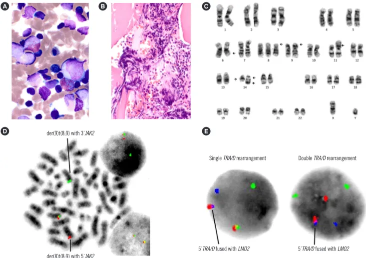 Fig. 2. BM examination, karyotyping, and FISH analysis at follow-up. (A) Eosinophils (Wright-Giemsa, ×1,000) and (B) focal fibrosis (HE, 