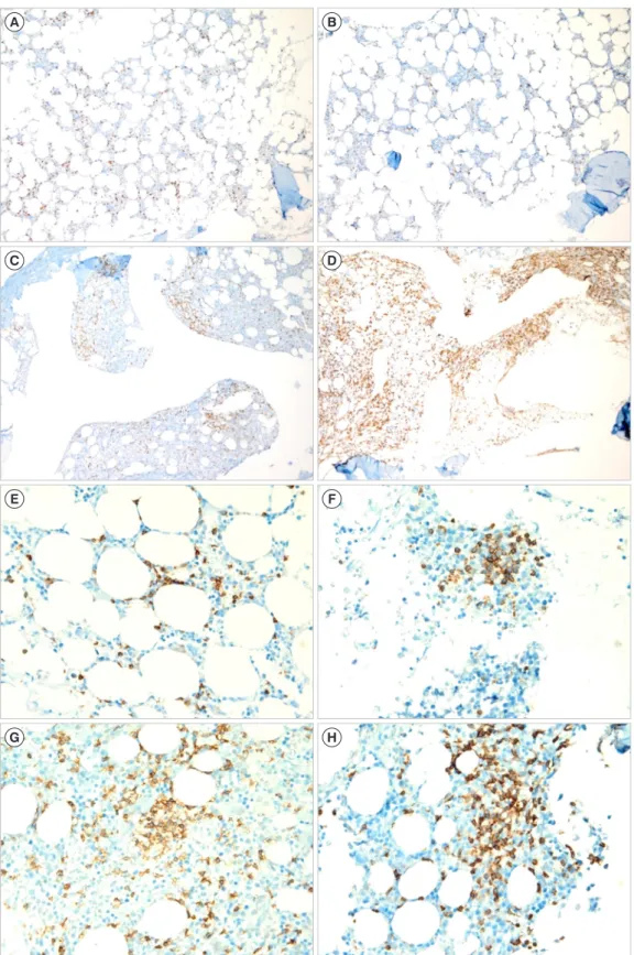 Fig. 1. Representative examples of bone marrow biopsies with various proportions of CD3 positivity in patients with peripheral T-cell lym- lym-phoma, not otherwise specified (CD3 immunohistochemical stain, ×100): (A) 10–25%, (B) 26–50%, (C) 51−75%, and (D)