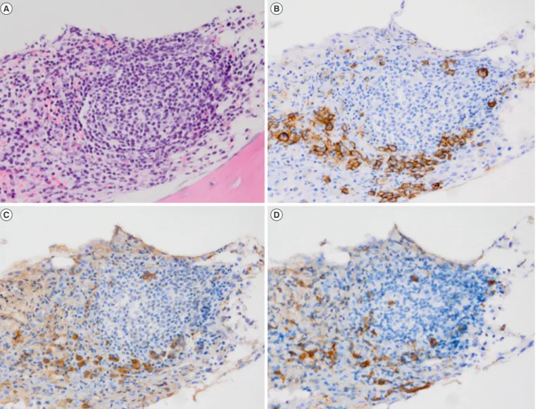 Fig. 1. Bone marrow finding of PCs rimming around a lymphocyte aggregate. (A) The lymphocytic aggregates show a germinal center (H&amp;E  stain, ×400)