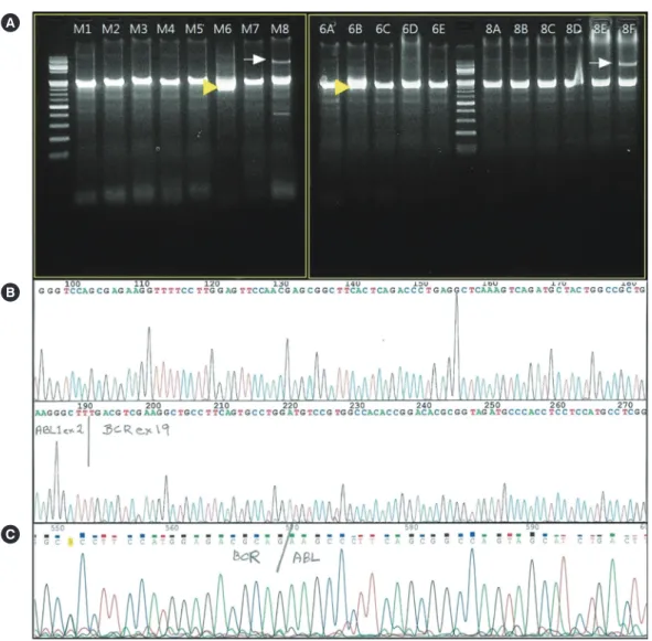 Fig. 2. Representative images of BCR-ABL1 rearrangement in the present case. (A) Positive bands in commercial multiplex RT-PCR indi- indi-cating e19a2: one (yellow arrowhead) is in Master M6 and Split-out M6B PCR, and presented as an atypically thick band 
