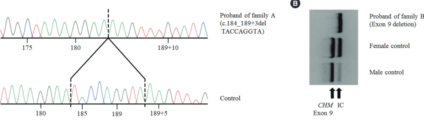 Fig. 2.  CHM variants identified in the probands of family A and family B. (A) Chromatogram of c.184_189+3delTACCAGGTA (p.Tyr62_Gln- (p.Tyr62_Gln-63del) detected in the proband of family A