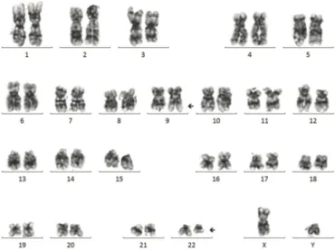 Fig. 2. Karyotype analysis results of the patient after initial evaluation  of the peripheral blood smear and bone marrow examinations