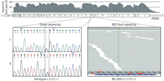 Fig. 3. DNA electropherograms of a fragment of the  PROM1 gene by Sanger sequencing. Proband DNA sequence shows a heterozygous  missense variant (NM_006017.1: c.1117C>T).