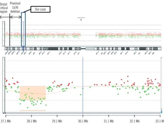 Fig. 2. Comparative genomic hybridization of chromosome 1 in the patient. Breakpoints were revealed in 1p36.11-p35.3 (27,750,155–