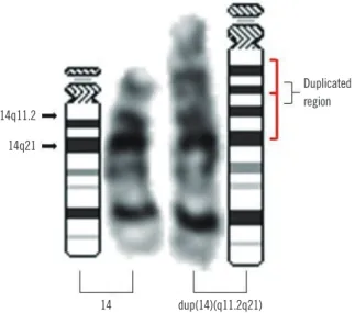 Fig. 2. Microarray analysis of chromosome 14 showed an 18.3-Mb duplication in the 14q11.2q21.1 (20,516,277–38,826,881) region (in- (in-dicated by the blue bar).