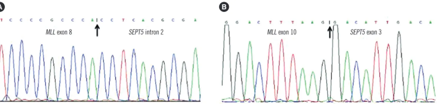 Fig. 3. Sequences of junction of the MLL-SEPT5 chimeric transcript.  (A) Patient 1, (B) patient 2.